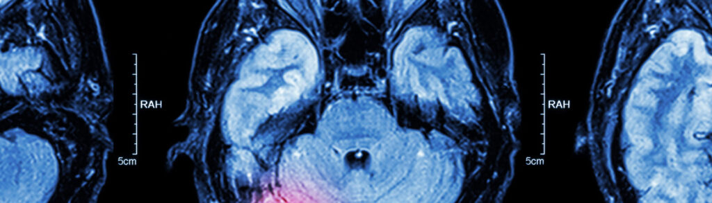 Axial brain MRI slices in blue hues with scale marks and 'RAH' labels on both sides.